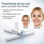Lápiz antiacné con luz azul para tratar imperfecciones de forma precisa